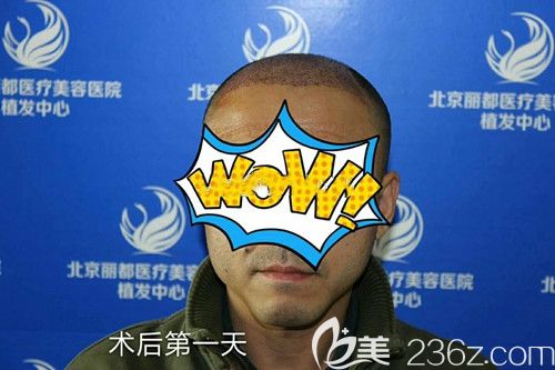 植發(fā)后當(dāng)天效果圖 植發(fā)后當(dāng)天效果圖