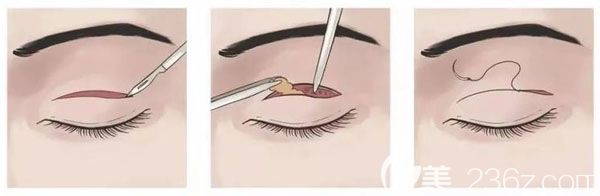 王建科割雙眼皮的技術(shù)優(yōu)勢(shì) 王建科割雙眼皮的技術(shù)優(yōu)勢(shì)