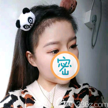 前額發(fā)際線種植一個月圖片