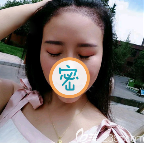 種植發(fā)際線一個禮拜