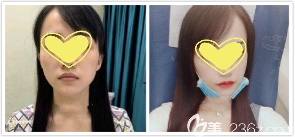 做完嘴角上揚術(shù)3個月前后療效