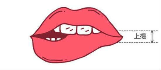 嘴角上揚術(shù)上提療效
