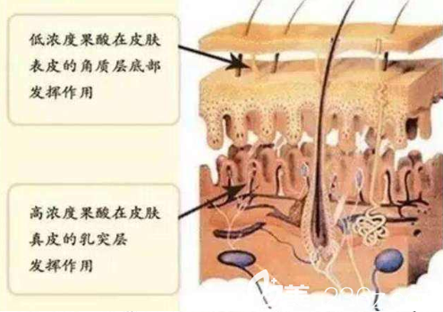 果酸換膚原理