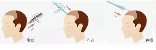 種頭發(fā)的原理及過(guò)程步驟 種頭發(fā)的原理及過(guò)程步驟