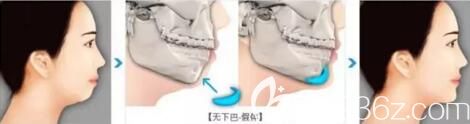 假體墊下巴改善前后對(duì)比效果圖