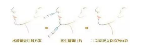 注射玻尿酸豐下巴介紹