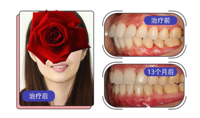  Insignia牙套的費(fèi)用