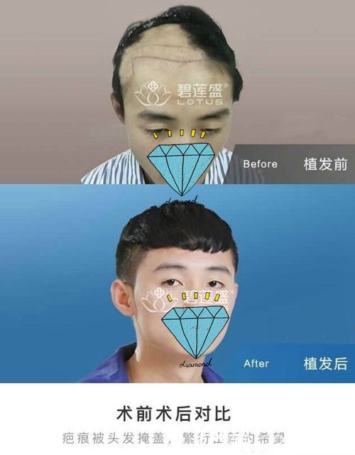 疤痕植發(fā)術(shù)前術(shù)后效果對(duì)比 疤痕植發(fā)術(shù)前術(shù)后效果對(duì)比