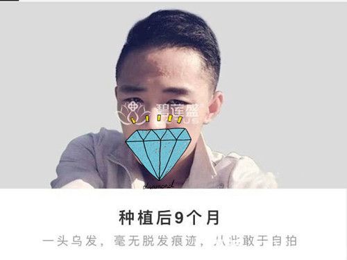 頭部疤痕植發(fā)者恢復(fù)效果分享：術(shù)后2個月3個月每天都有不一樣的變化