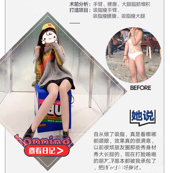 全身吸脂手術(shù)真人案例效果圖