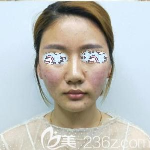 剛做完埋線提升出來(lái)臉部泛紅