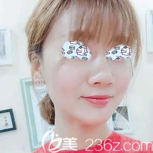 埋線提升術(shù)后8天組織已經(jīng)提升