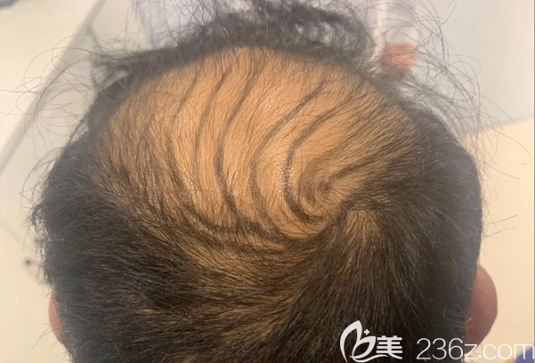 毛囊檢測后醫(yī)生給我設計的植發(fā)手術方案 毛囊檢測后醫(yī)生給我設計的植發(fā)手術方案