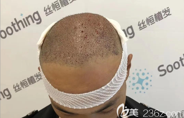 重新面診設(shè)計(jì)后，醫(yī)生決定微針加密3000毛囊單位拯救植發(fā)失敗案例