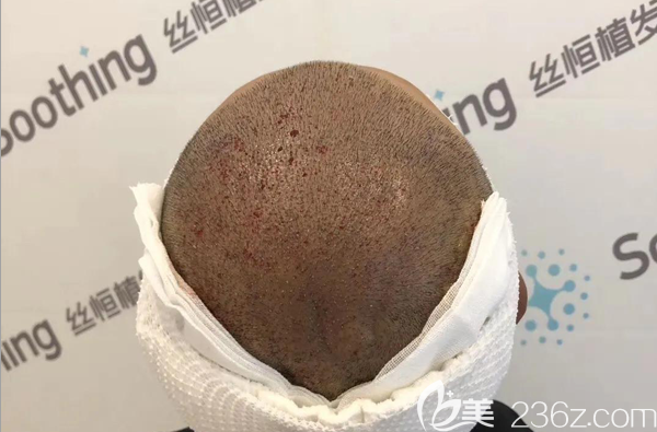 植發(fā)失敗修復手術術后效果 植發(fā)失敗修復手術術后效果