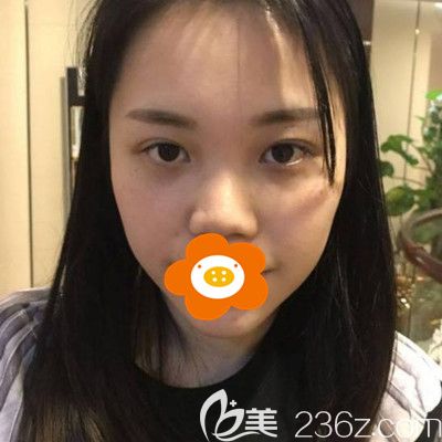 做隆鼻手術(shù)前我的照片 做隆鼻手術(shù)前我的照片