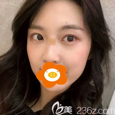 術(shù)后半個月效果 術(shù)后半個月效果