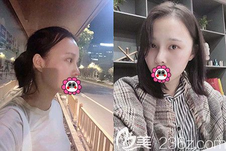 杭州時光胡斌做鼻子怎么樣？