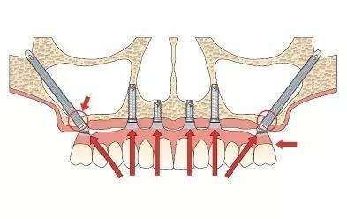 穿顴穿翼種植技術(shù)