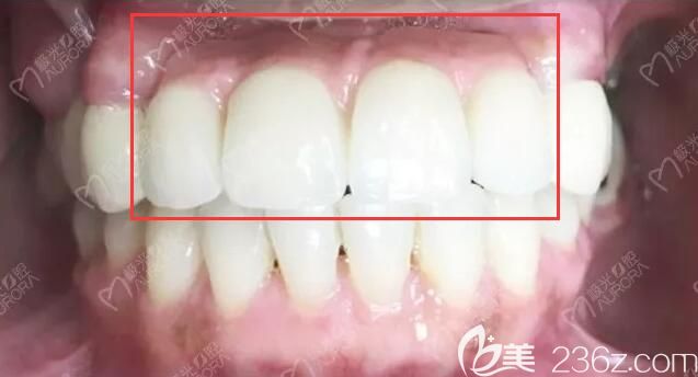 我家男神門牙缺失4顆,做的瑞典諾貝爾種植牙效果挺盡人意,但價(jià)格有點(diǎn)肝疼