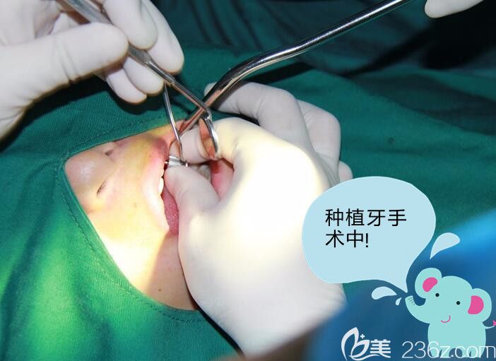 種植牙手術(shù)過程