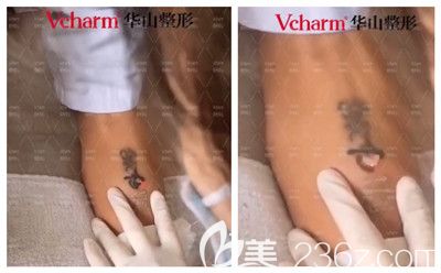 皮秒洗紋身后即刻的改變 皮秒洗紋身后即刻的改變