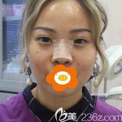 術(shù)后一周拍的照 術(shù)后一周拍的照