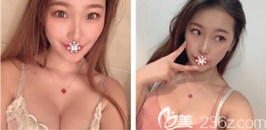 覺得做胸也沒那么痛苦我6萬多選了個(gè)麥格假體做完三個(gè)月了沒啥不舒服的