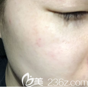 沒想到我只做了一次超皮秒祛斑臉上的雀斑就沒有了只剩痣還隱約看得見