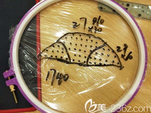 發(fā)際線調(diào)整費用的計算方法