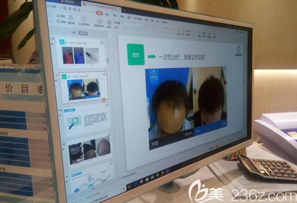 給顧客展示植發(fā)效果的專業(yè)案例