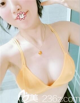 220cc曼托假體胸對我這種個子160cm的人來說大小剛合適！