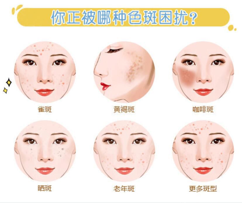 斑的種類和類型