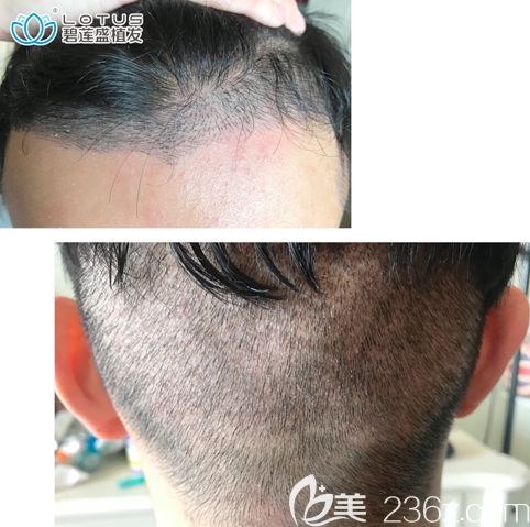 看下我做發(fā)際線種植后的樣子