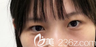 去眼袋手術(shù)前的樣子 去眼袋手術(shù)前的樣子