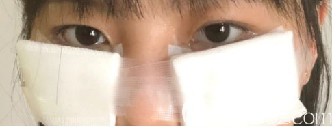 去眼袋手術(shù)后的第二天 去眼袋手術(shù)后的第二天