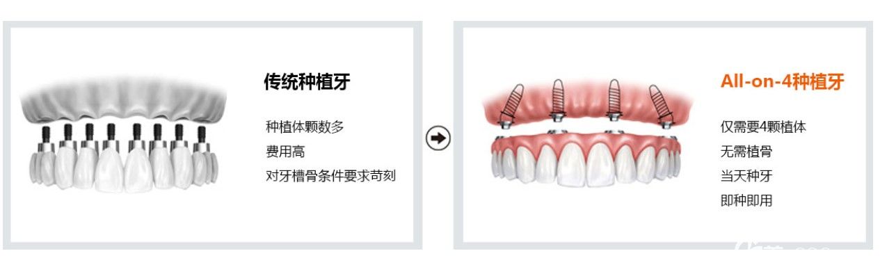 all-on-4即刻種植牙技術(shù) all-on-4即刻種植牙技術(shù)