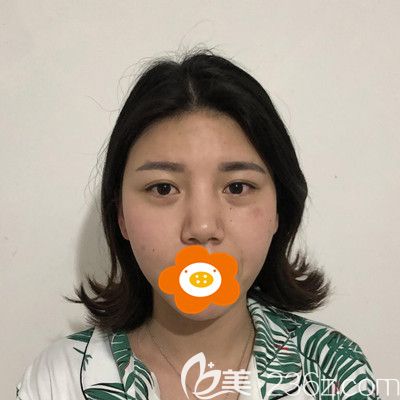 術(shù)后第4天臉還有點(diǎn)腫 術(shù)后第4天臉還有點(diǎn)腫