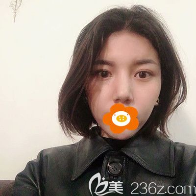 誰說玻尿酸填充臉頰后臉會變寬?我注射愛芙萊豐面頰半年面部飽滿自然！??！