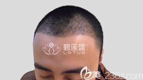 術后90天，種植頭發(fā)自然、發(fā)際線完整