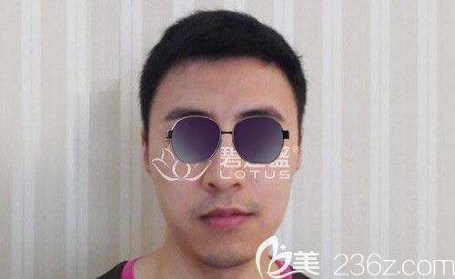 我屬于前額m型脫發(fā)，在使用米諾地爾無果后選擇了前額發(fā)際線種植！