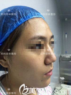 駝峰鼻手術(shù)前照片 駝峰鼻手術(shù)前照片