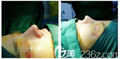 駝峰鼻術(shù)后即刻 駝峰鼻術(shù)后即刻