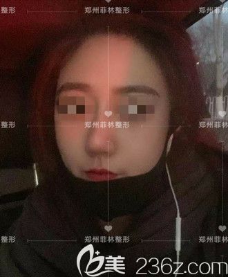 駝峰鼻矯正手術(shù)后一個(gè)月 駝峰鼻矯正手術(shù)后一個(gè)月