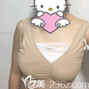 自體脂肪隆胸初次術(shù)后 自體脂肪隆胸初次術(shù)后