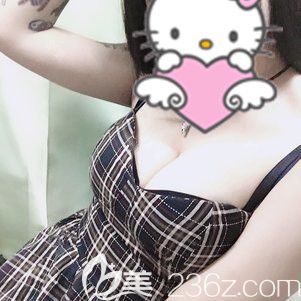 大家常說千萬別做自體脂肪隆胸，填充2次后的我來打破這個(gè)謠言