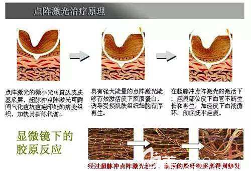點陣激光治療痤瘡