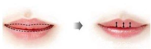 厚唇改薄術(shù)原理