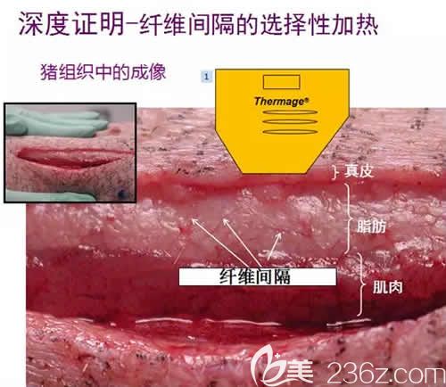 熱瑪吉的作用原理 熱瑪吉的作用原理