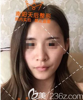 南陽(yáng)天后醫(yī)療美容門診部張銳術(shù)前照片1